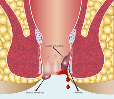 anal fissure treat